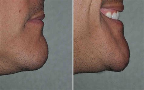Plastic Surgery Case Study - Chin Reduction Surgery by Vertical Bone Reduction, Prejowl Implants ...