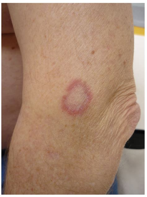 Erythema Annulare Centrifugum Histology