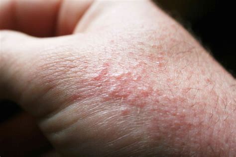 Common Foot Rashes and How to Treat Them - skin rash on foot