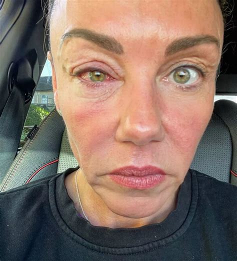 Michelle Heaton struggling to see as she unveils horrific Celeb SAS 'swamp eye' injury - Daily Star