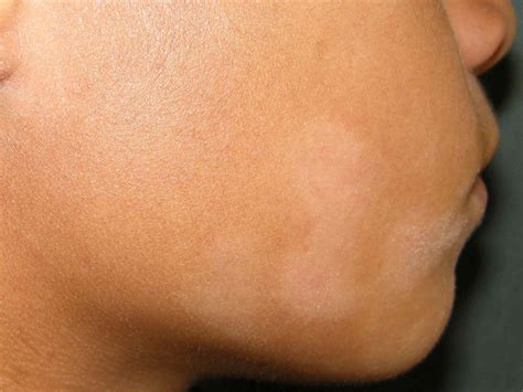 White Spots on Skin: Causes, Treatments, and Seeking Care