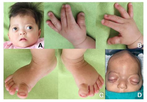 Clinical and Genetic Studies of the First Monozygotic Twins with Pfeiffer Syndrome