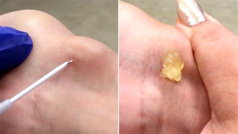 Bible Cyst Pop