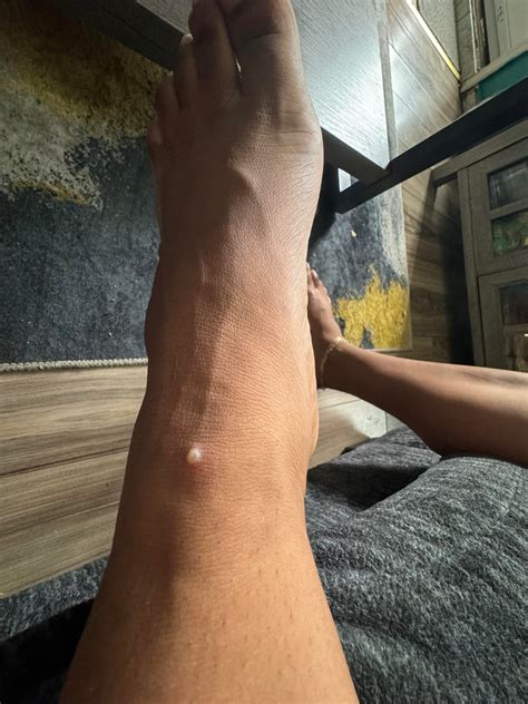 pimple popping community
