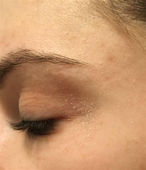 [misc] Recommendations for dry flaky skin around eyes | Dry skin around eyes, Dry skin on face ...