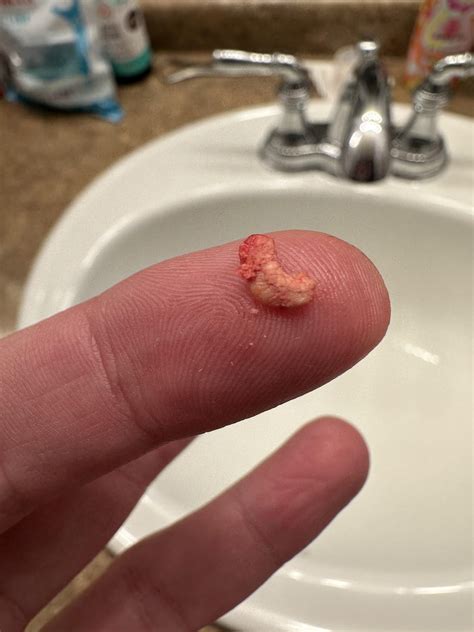 Giant sebaceous cyst gunk! It’s gross :) : r/PimplePoppersDelight