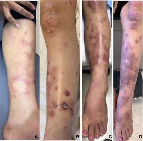 Postpartum sepsis-like illness and rash associated with Hansen’s disease