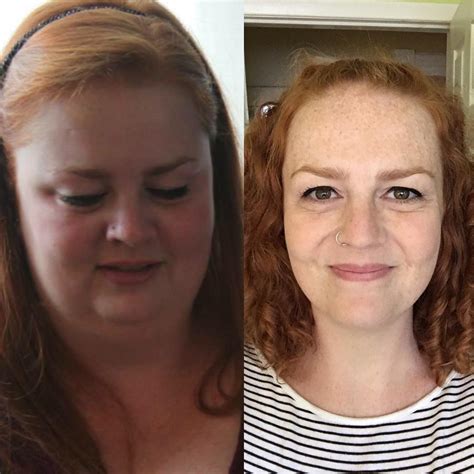Top 105+ Pictures Cushing's Syndrome Cushing's Disease Before And After Photos Latest