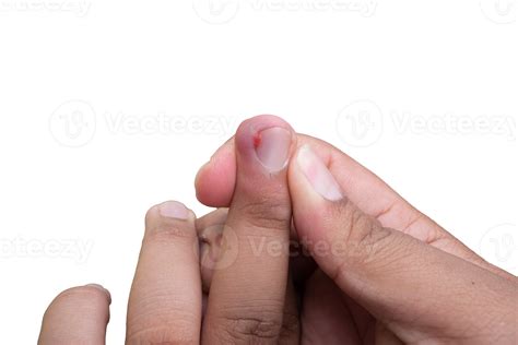 selective focus on bruised middle fingernails due to ingrown nails. in Indonesian it is called ...