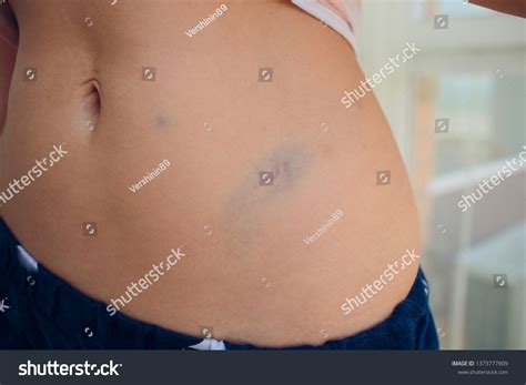 Bruise On Tummy