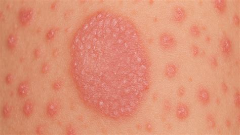 Understanding Pityriasis Rosea: Symptoms & Treatment