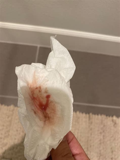 Bloody Tissue Discharge