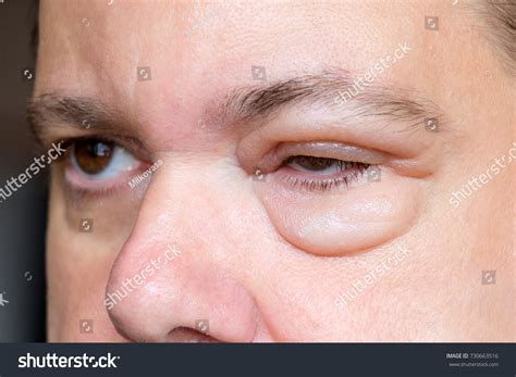 Bug Bite Swollen Eyelid Treatment Fast at Victoria Gregory blog