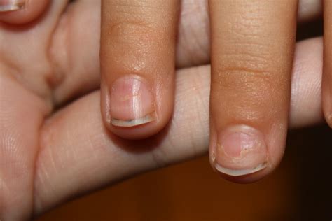 Why Are My Nails Lifting From Nail Bed at Benjamin Marcial blog