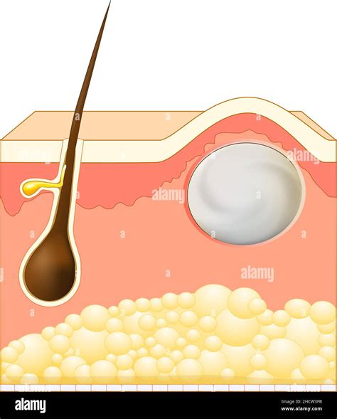 Sebaceous Cyst Diagram