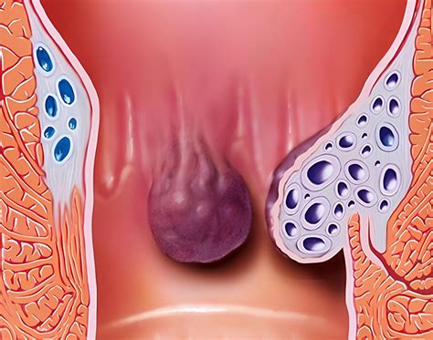 Piles (Hemorrhoids) Singapore | Colorectal Specialist