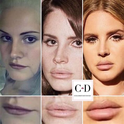 Lana Del Rey | Plastic surgery photos, Bad celebrity plastic surgery, Nose plastic surgery