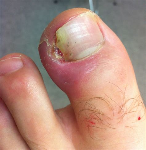 What is an Ingrown Toenail? | The Ingrown Toenail Centre