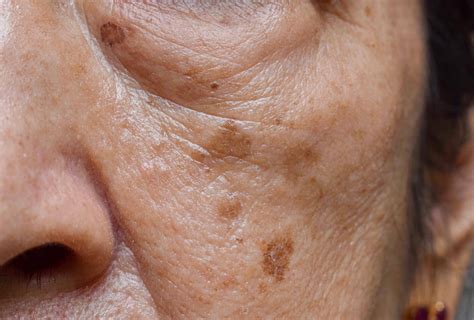 Pigmentation removal and the ageing process
