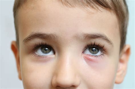 Pink Eye vs. Stye: How to Tell the Difference | Vancouver