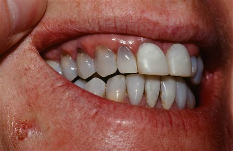 minocycline_pigmentation_rd