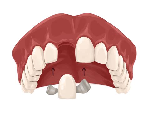 Dental bridge costs from $700 up to $2,100 | Authority Dental