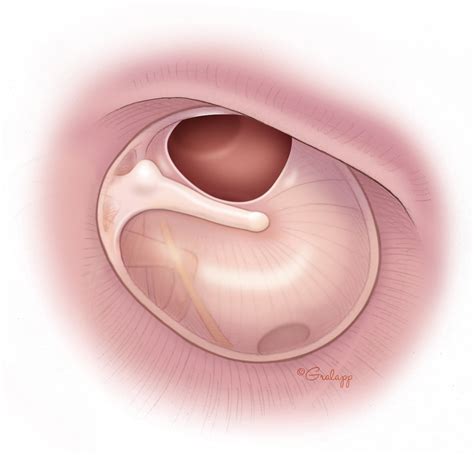 Tympanic Membrane Perforation Repair