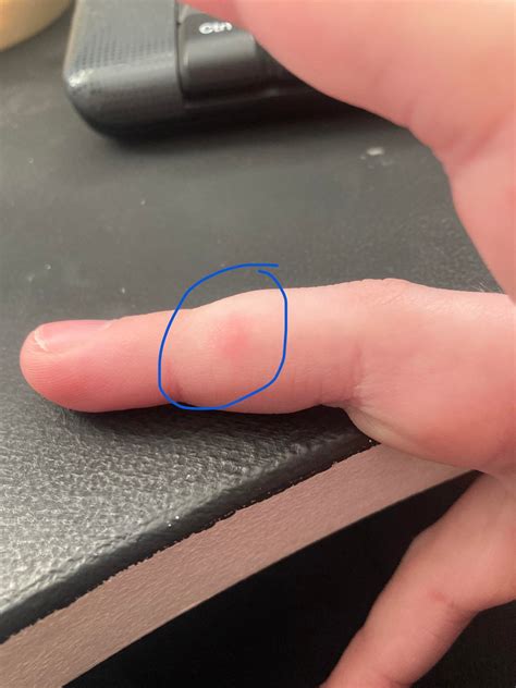 Painful red bumps on fingers : r/DiagnoseMe