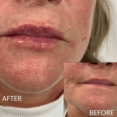 Lip Filler Before and After: MySkyn Clinic