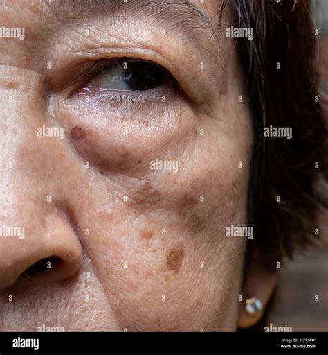 Small brown patches called age spots on face of Asian elder woman. They are also called liver ...