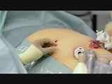 Preperitoneal Catheter as Pain Control Therapy After Laparoscopic Surgery • Video • MEDtube.net