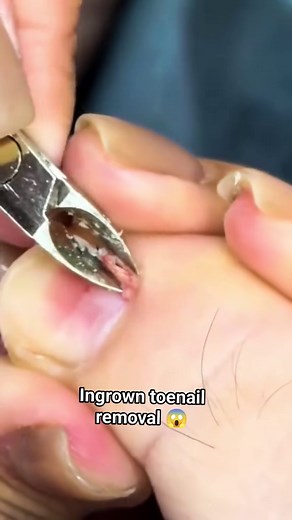 Effective Ingrown Toenail Removal Techniques