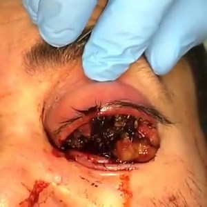 Maggots In The Eyes