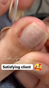 ingrown toenail #satisfying #ingrownnail #fblifestyle | Ruth Agbisit Vlog