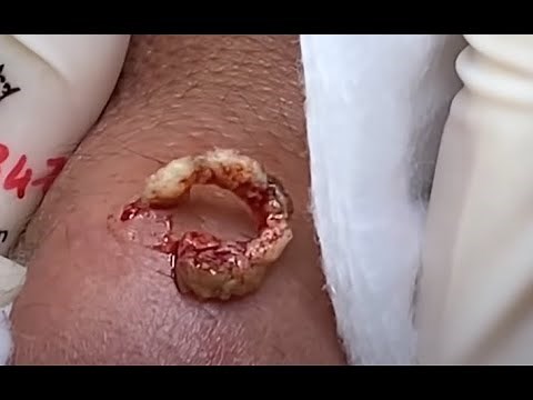 Intense Pimple Popping! **MULTIPLE PUS EXPLOSIONS**