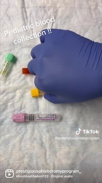Microtainer Blood Collection Tubes are widely used in pediatric blood collection they facilitate collection of a high-quality capillary blood samples. They ensures thorough mixing between blood and additive. Tubes are color-coded to indicate additive •• Lavender K2 EDTA Whole blood Hematology 10 inversions •• Mint Green- Lithium Heparin and Serum Gel for plasma separation -chemistry 10 inversions •• Gold- Clot Activator and Gel for serum separation Serum Chemistry 5 inversions •• Red- No additiv