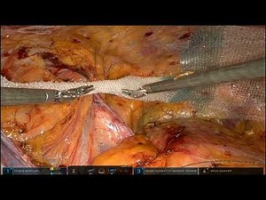 Robotic R-TAPP Bilateral inguinal hernia repair