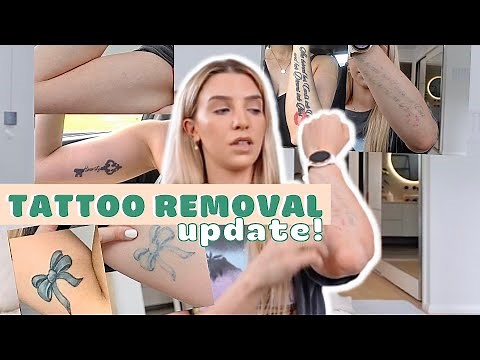 TATTOO REMOVAL UPDATE!!/ LASER TATTOO REMOVAL/ Come along with me/ Progress/ Steph Pase
