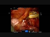 Robotic Assisted Left Upper Lobectomy  • Video • MEDtube.net