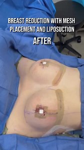 Before & After: Breast Reduction with Absorbable Mesh Support