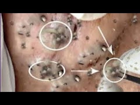 Best Pimple Popping Videos 2021 - Blackheads Removal #021