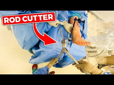 INSIDE THE OR: Ankle Spanning External Fixator