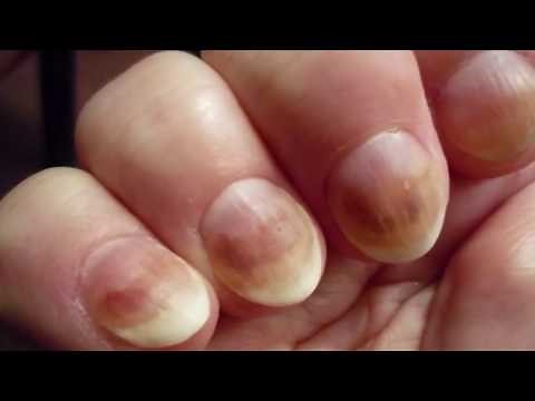 Solar Comedones vs Senile Comedones - #1 Blackhead Mask!