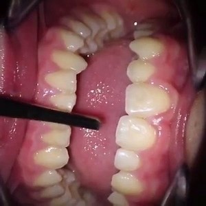Ankylosis tooth 😱 The percussion sound is dull 🔝?? | Dr Moin Khan