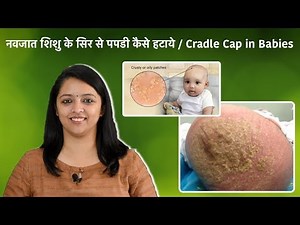 सिर से पपडी कैसे हटाये | How To Get Rid Of Cradle Cap In Babies