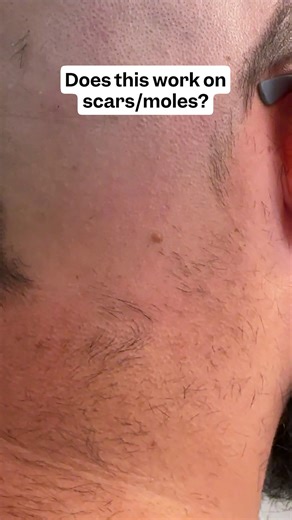 HOLIDAY SALE! 🎅✨ FlexSeries® Pro shaves smooth, gentle on scars and moles! #Freebird #FlexSeries #FlexSeriesPro #BaldAndBeautiful #HeadShavers #MenGrooming #ShavingRoutine #BaldCare #TrendingNow #SmoothShave #BeardCare #BaldHead #MensStyle #SkincareRoutine #MenFashion #BaldIsBeautiful #BaldMen #BaldWomen #HeadShave #BuzzCut #FYP | Freebird