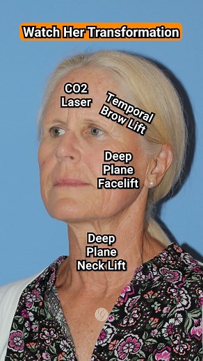 Her Results Though 🤩Vertical Facelift is a cosmetic surgical procedure that involves a combination of 𝐝𝐞𝐞𝐩 𝐩𝐥𝐚𝐧𝐞 𝐟𝐚𝐜𝐞 𝐥𝐢𝐟𝐭𝐢𝐧𝐠 and 𝐭𝐞𝐦𝐩𝐨𝐫𝐚𝐥 𝐛𝐫𝐨𝐰 𝐥𝐢𝐟𝐭𝐢𝐧𝐠 to achieve a more youthful and refreshed appearance. This technique is used to address sagging skin and jowls in the lower face, as well as deep wrinkles and drooping eyebrows in the upper face.The goal of a vertical facelift is to create a 𝐡𝐞𝐚𝐫𝐭-𝐬𝐡𝐚𝐩𝐞𝐝 𝐟𝐚𝐜𝐢𝐚𝐥 𝐜𝐨𝐧𝐭𝐨𝐮𝐫 that is defined
