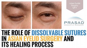 The Asian Eyelid Surgery Healing Process With Dissolvable Sutures