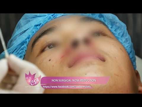 how to make nose smaller without surgery in minutes