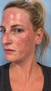 1K views | Lumecca IPL #photofacial process. These results are after...